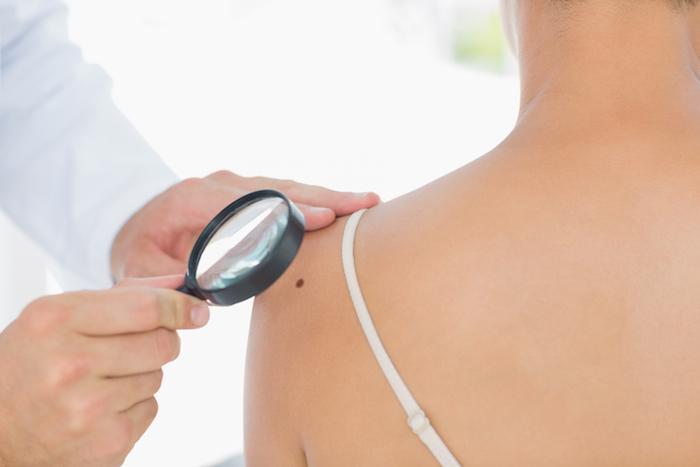 When Should I Be Concerned About a Mole?
